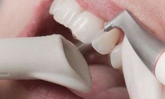 Чистка зубов air flow – что это такое?