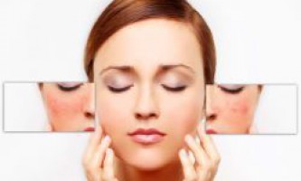 Купероз на лице – причины и лечение