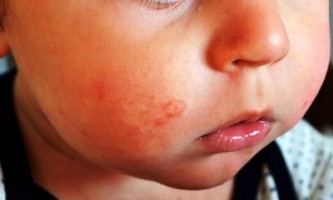 Сыпь на щеках у ребенка
