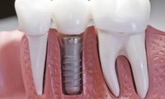 Зубные импланты – «за» и «против»